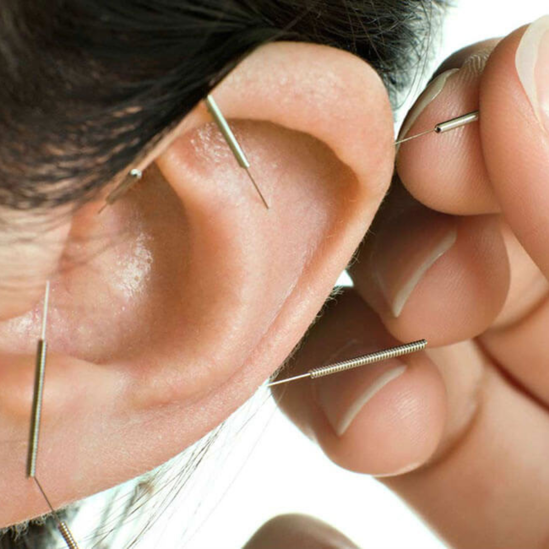 Terapia Auricular - AURICULOTERAPIA